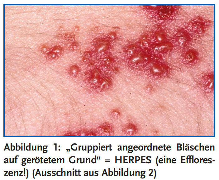 Abbildung 1: „Gruppiert angeordnete Bläschen auf gerötetem Grund“ = HERPES (eine Effloreszenz!)
