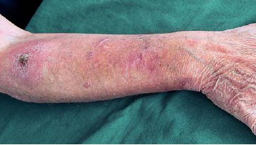 Hautatrophie und multiple aktinische Keratosen bei einem 43-jährigen Patienten