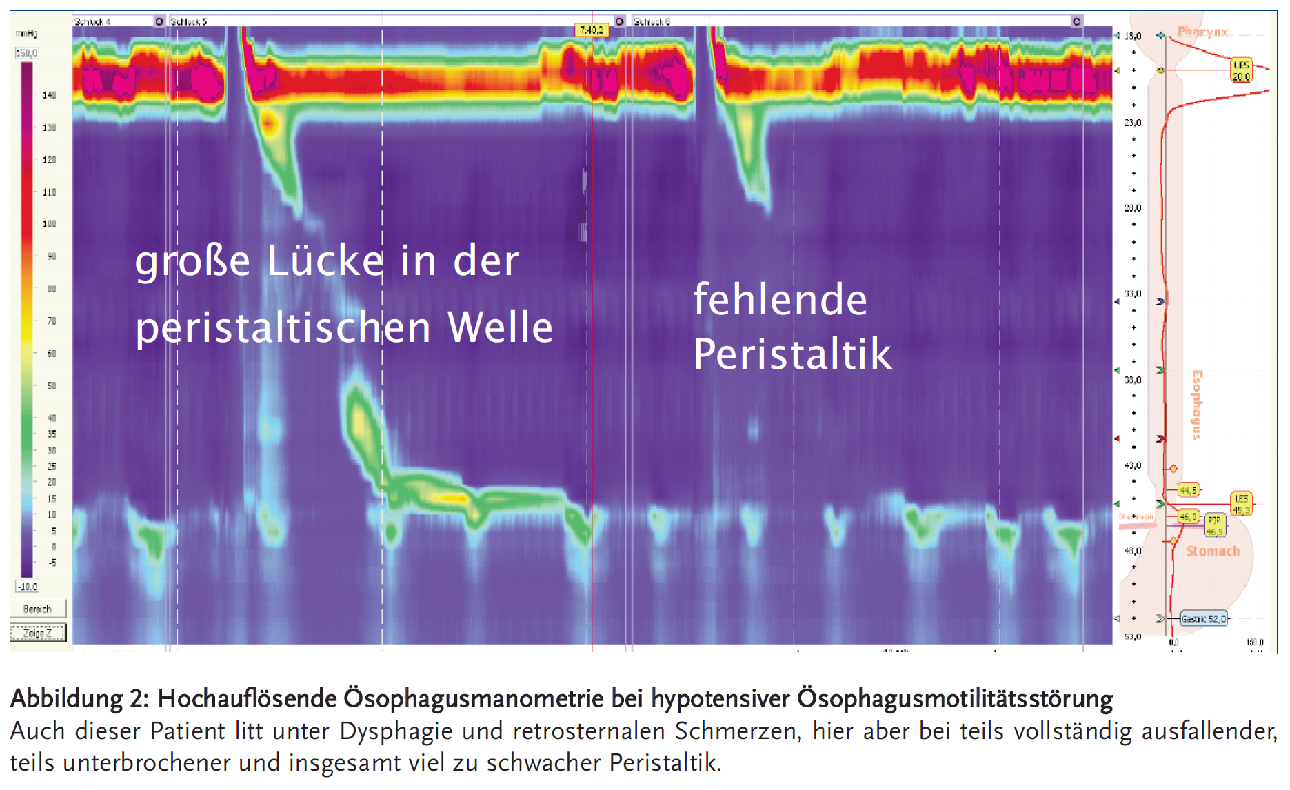 Abbildung 2: Hochauflösende Ösophagusmanometrie bei hypotensiver Ösophagusmotilitätsstörung