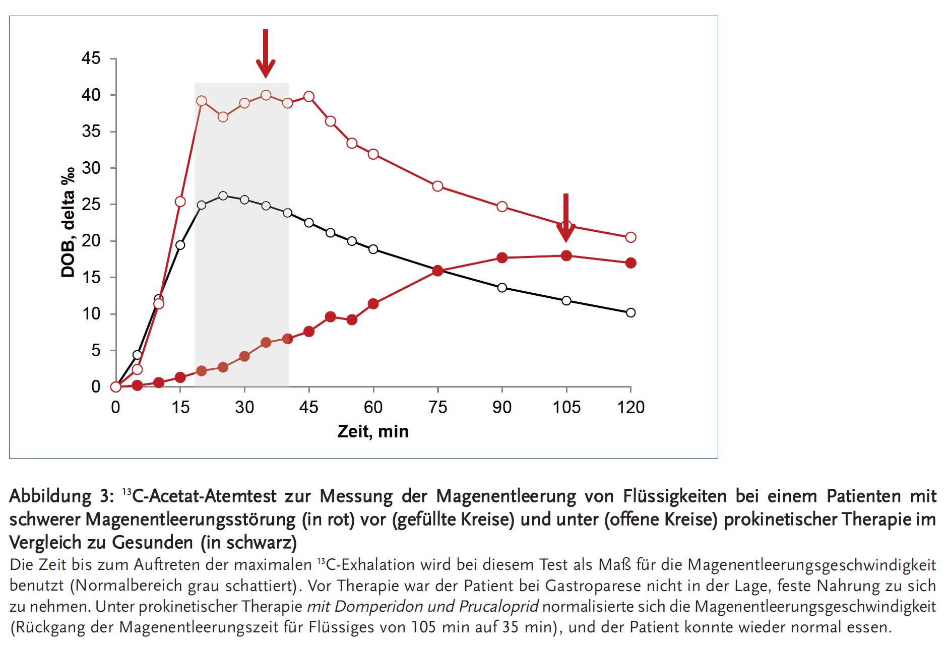 Abbildung 3: <sup>13</sup>C-Acetat-Atemtest zur Messung der Magenentleerung von Flüssigkeiten bei einem Patienten mit schwerer Magenentleerungsstörung (in rot) vor (gefüllte Kreise) und unter (offene Kreise) prokinetischer Therapie im Vergleich zu Gesunden (in schwarz)