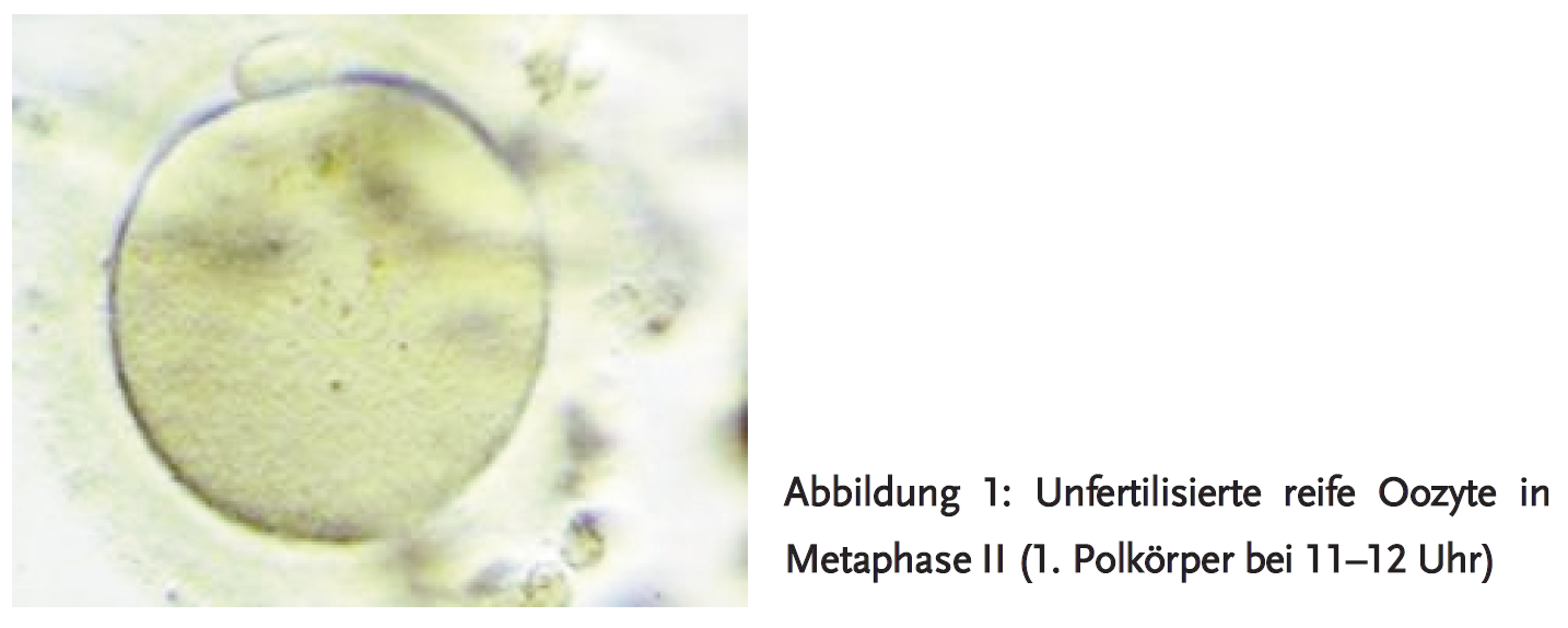 Abbildung 1: Unfertilisierte reife Oozyte in Metaphase II (1. Polkörper bei 11–12 Uhr)