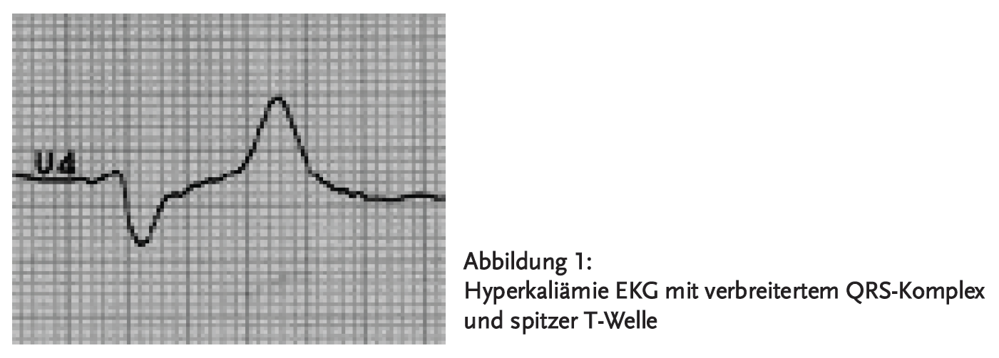 Hyperkaliämie EKG mit verbreitertem QRS-Komplex und spitzer T-Welle